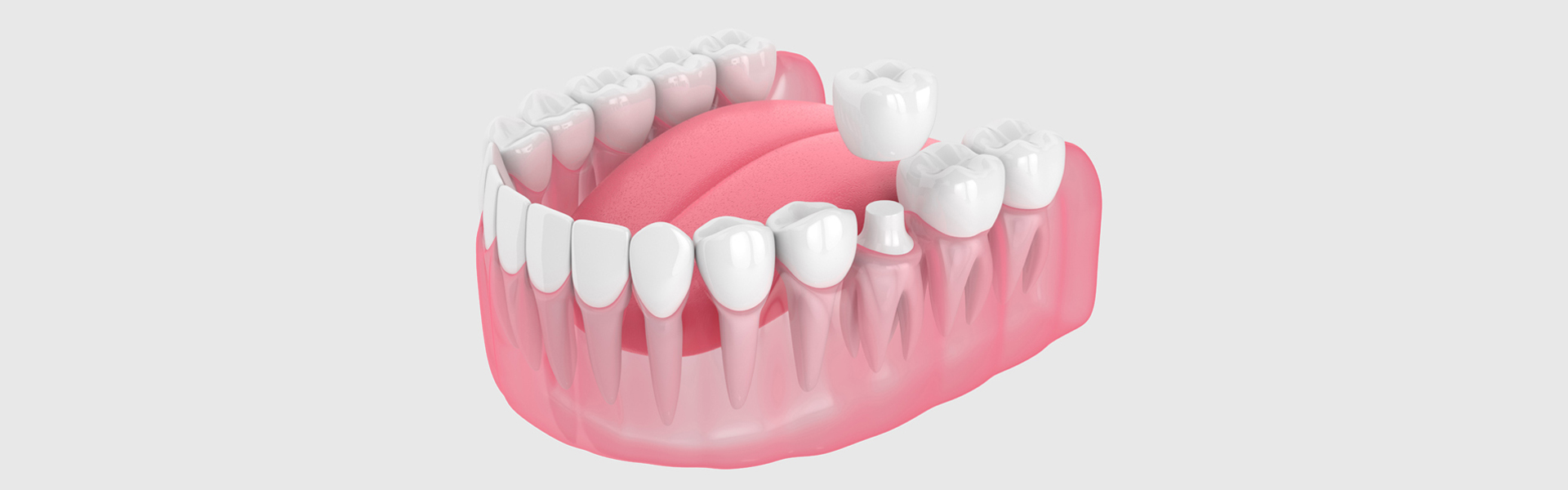 Restoring Both Beauty and Functionality: The Power of Dental Crowns