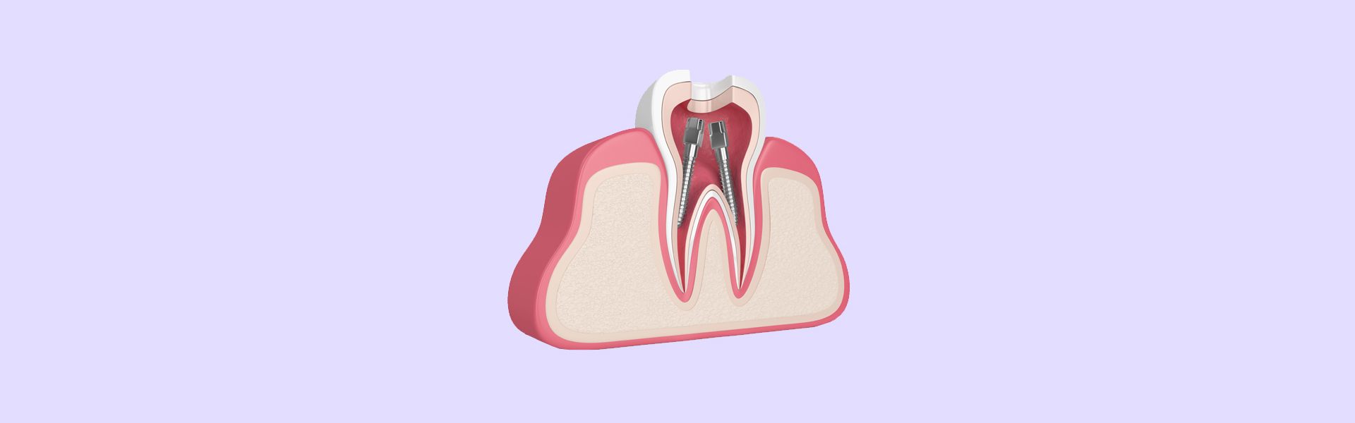 What Does a Root Canal Feel Like? Understanding the Sensations and Symptoms
