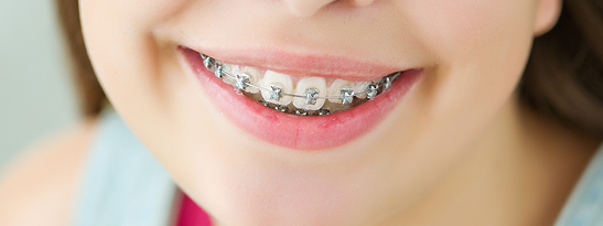 Tired of Braces That Stand Out?